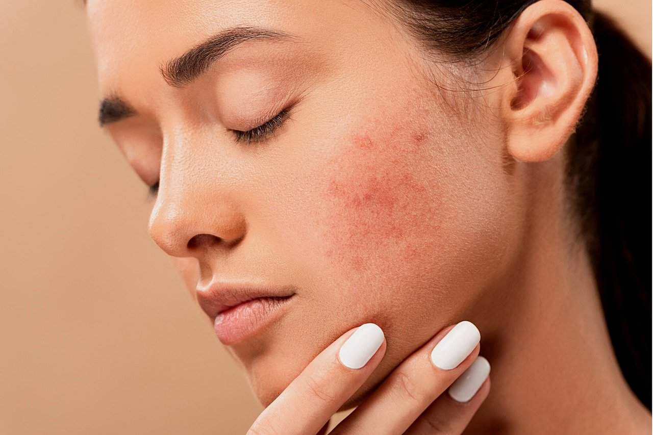 acne-treatment