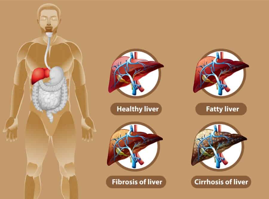 Symptoms of Fatty Liver